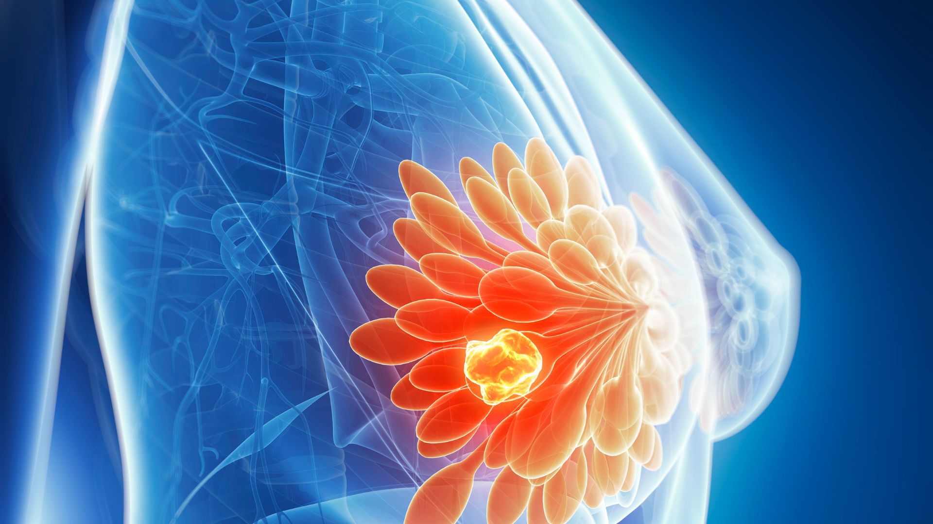 ¿Qué es un Fibroadenoma de Mama?